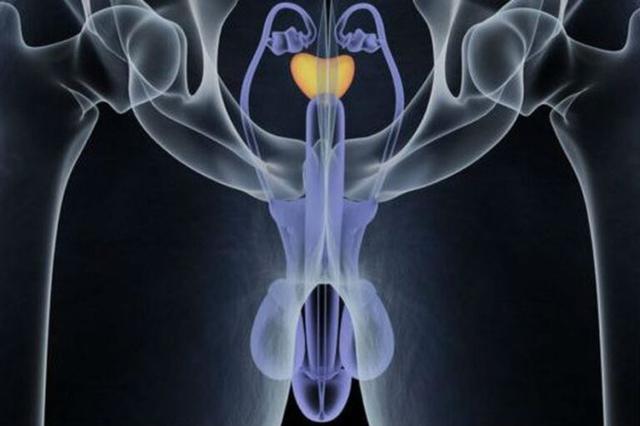 Cáncer de próstata: la prevención es el mejor aliado. Lanacion.com.ar