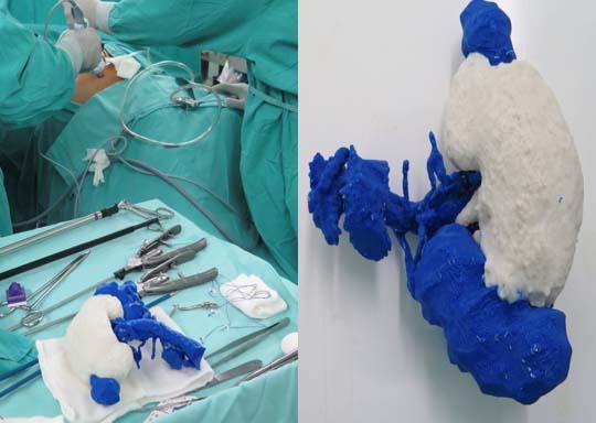 Impresiones 3D para Nefrectomías Parciales Laparoscópicas Complejas