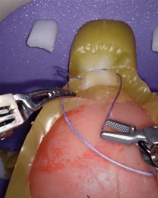 Detalhe técnico de prostatectomia radical robótica · sutura sobre modelo institucional · técnica UMIBA