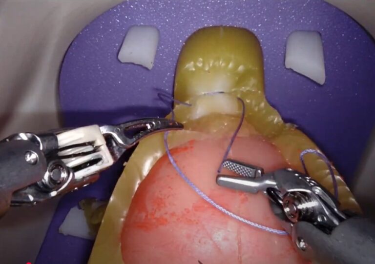 Robotic radical prostatectomy on a high-realism silicone model