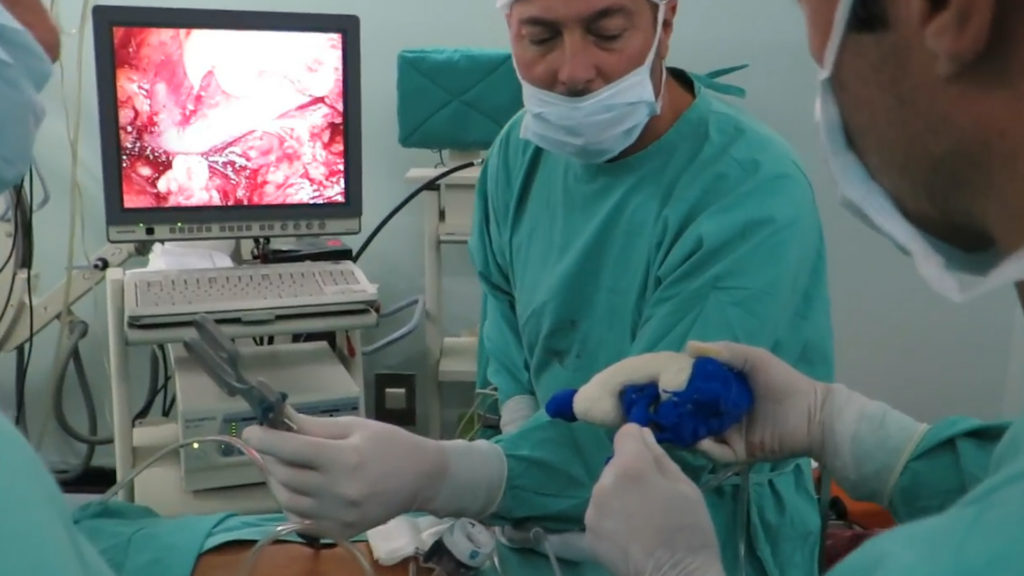 Biomodelo 3D de MIRAI desplegado en pantalla auxiliar durante una nefrectomía parcial robótica